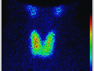 Scintigraphy of a thyroid gland